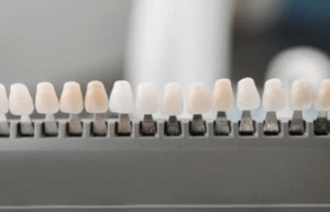 Porcelain Veneers