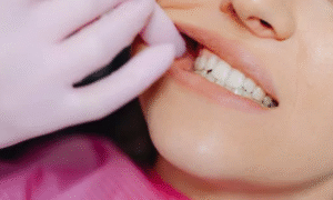 The Composite Bonding Procedure for Gaps