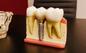 The Implant Post