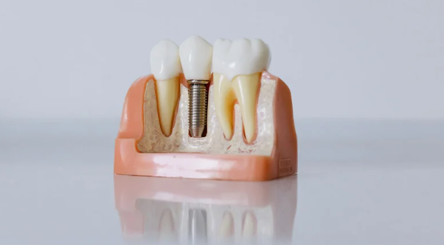 What Are the Different Types of Dental Veneers Available in India